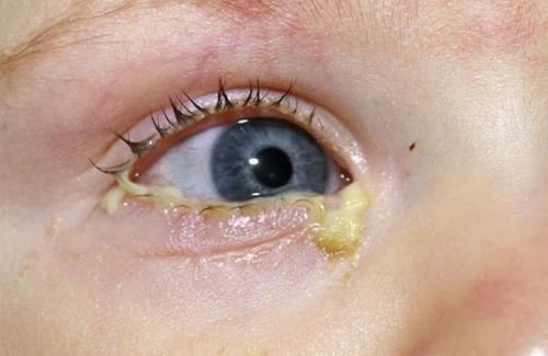 Dấu hiệu bệnh đau mắt hột đặc trưng dễ phát hiện nhất