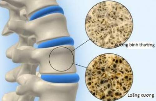 Dấu hiệu của bệnh loãng xương và một số cách ngăn ngừa bệnh