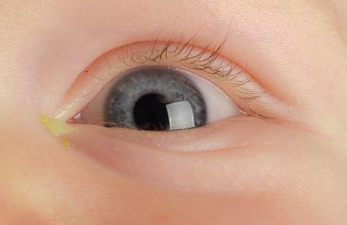 Dấu hiệu đau mắt hột biểu hiện cụ thể như thế nào?