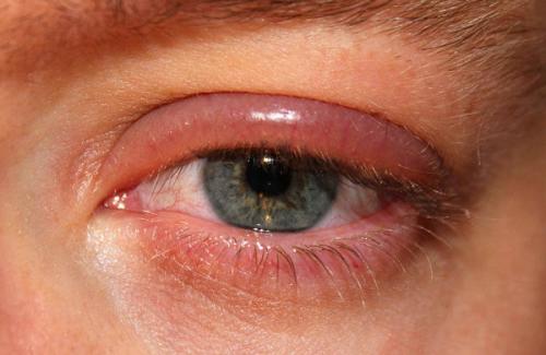 Bệnh đau mắt hột - biến chứng và cách phòng bệnh dứt điểm