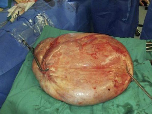 Khó thở vì khối u tử cung “khổng lồ” dài hơn 41 cm và nặng hơn 25kg