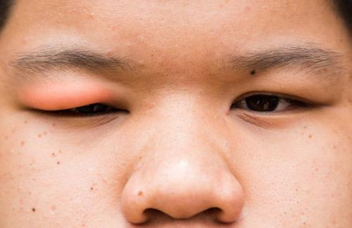 Nguyên nhân đau mắt hột ở trẻ em và người lớn như thế nào?