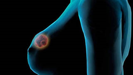 Triệu chứng giai đoạn sớm của ung thư vú bạn cần phải biết