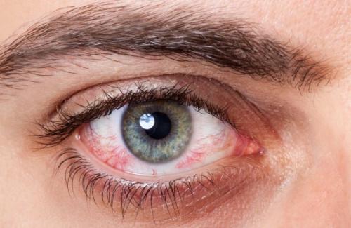 Triệu chứng bệnh đau mắt hột đặc trưng và dễ nhận biết nhất