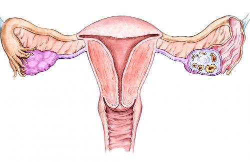 Làm sao để phát hiện sớm bệnh ung thư nội mạc tử cung?