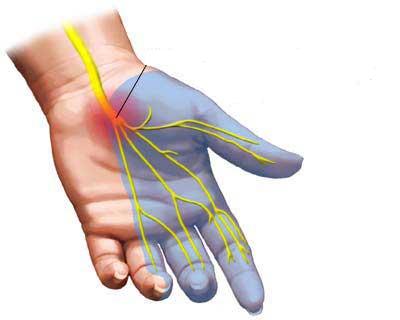 Hội chứng ống cổ tay, thoái hóa cột sống là thủ phạm gây nên chứng tê tay chân