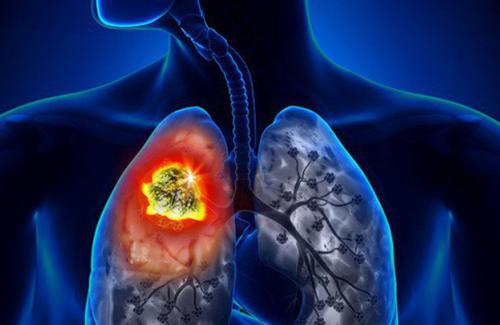 Những dấu hiệu cảnh báo bạn bị ung thư phổi, ung thư vòm họng