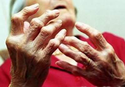 Một số nguyên nhân dẫn đến thoái hóa khớp bàn tay, cổ tay