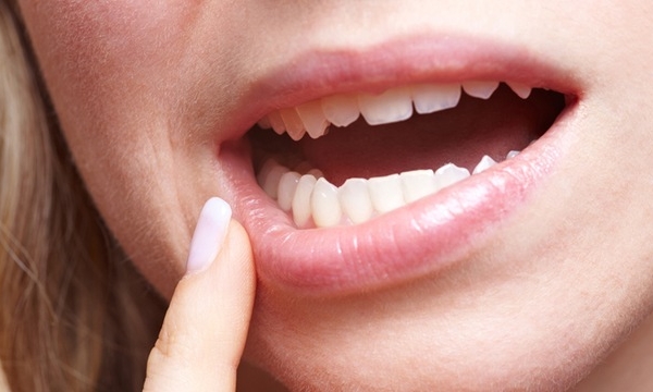 Những biểu hiện thường thấy cuả bệnh viêm loét miệng