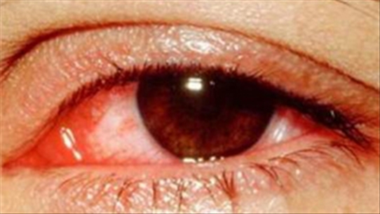 Những dấu hiệu phân biệt bệnh đau mắt đỏ với viêm nội nhãn