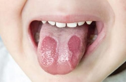 Ung thư lưỡi là một trong những loại phổ biến nhất ở khoang miệng