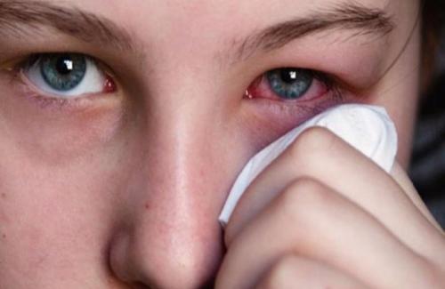 Bỏ túi một vài mẹo nhỏ tránh viêm mắt, đau mắt trong mùa nóng