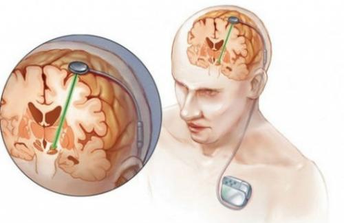 Kích thích não sâu giúp làm chậm quá trình phát triển bệnh Parkinson