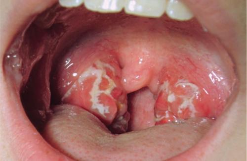 Hãy nhìn vết loét trên miệng để biết bạn có bị ung thư hay không?