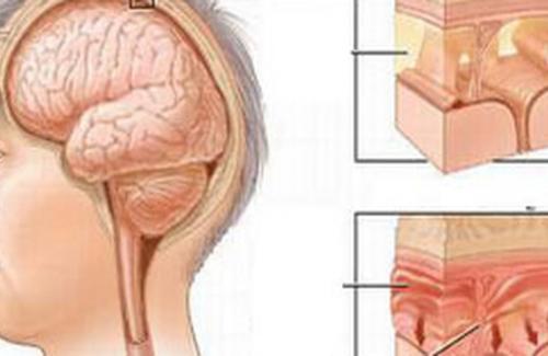 Một số biến chứng nguy hiểm của bệnh viêm màng não mủ