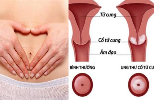 8 nguyên nhân ung thư cổ tử cung phổ biến nhất là gì?