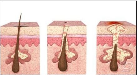 Nguyên nhân và cách phòng tránh căn bệnh viêm nang lông