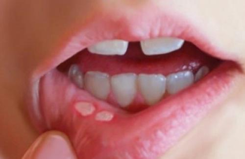 Viêm loét miệng: Phòng tránh và chữa bệnh như thế nào?
