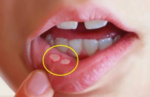 Một số dấu hiệu và biểu hiện của viêm niêm mạc miệng