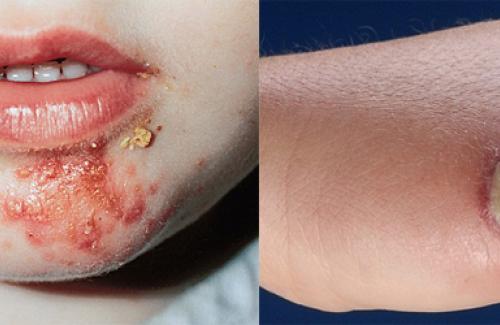 Viêm da mủ do liên cầu khuẩn - Căn bệnh thường gặp vào mùa hè