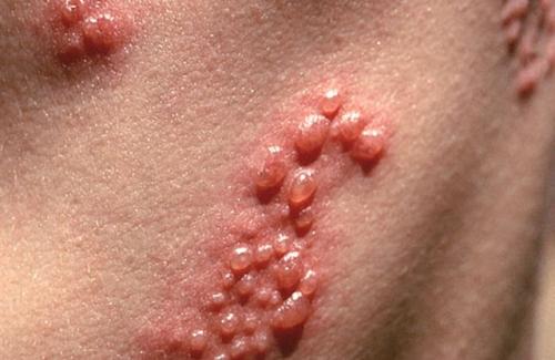 Bệnh viêm da tiếp xúc kích ứng và cách chăm sóc da thích hợp