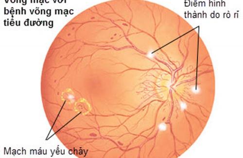 Võng mạc tiểu đường: Cần phòng ngừa sớm để bảo vệ thị lực