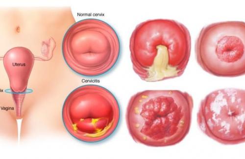 Nguy cơ và biểu hiện của căn bệnh viêm lộ tuyến cổ tử cung