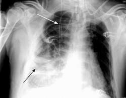 Biến chứng của viêm mủ màng phổi có thể nguy hiểm đến tình mạng