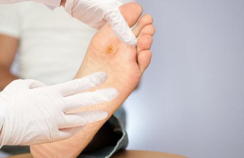 Một số tổn thương ở bàn chân do bệnh đái tháo đường và cách phòng ngừa