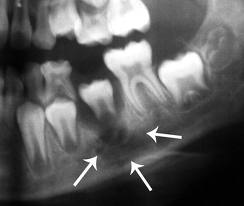 Tụ cầu khuẩn vàng - mầm bệnh thường gặp gây ra viêm xương tủy hàm