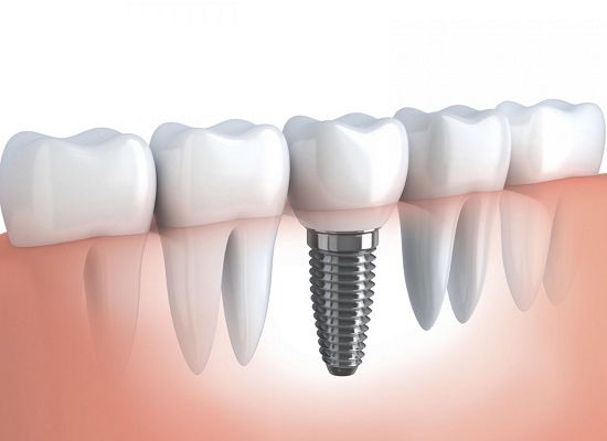 Những lưu ý bạn cần biết sau phục hình răng bằng cấy ghép implant