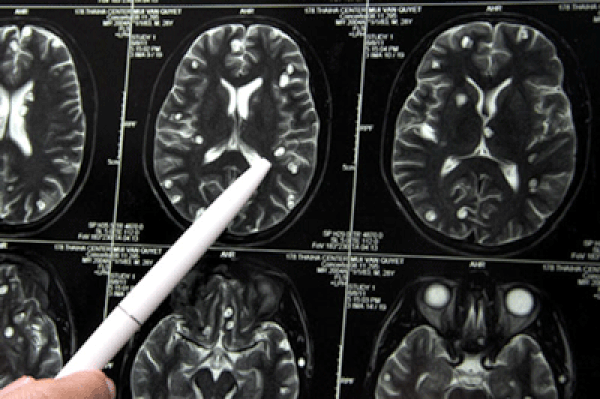 Nguyên nhân và những triệu chứng của căn bệnh sán não