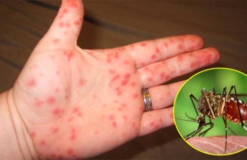 Căn bệnh sốt xuất huyết theo y học cổ truyền có mấy giai đoạn?