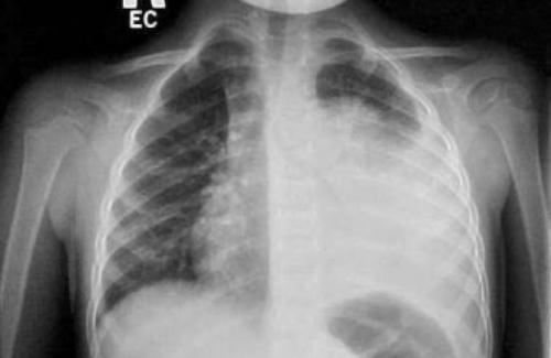 Nhận biết sớm bệnh lý viêm mủ màng phổi bằng cách nào?
