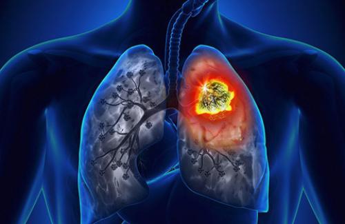 Liệu pháp hiệu quả trong điều trị ung thư phổi, ung thư hạch
