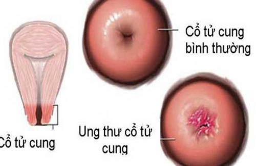 Virut gây u nhú ở người - Thủ phạm gây ra ung thư cổ tử cung