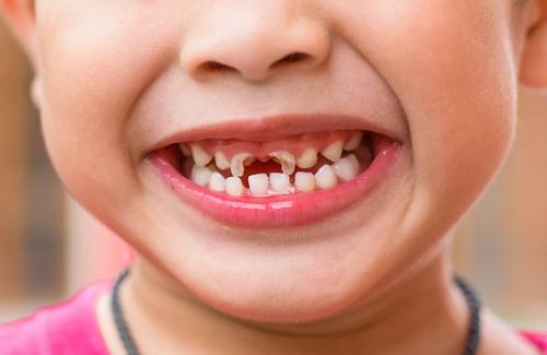 Nguyên nhân và một số cách để phòng chống sâu răng
