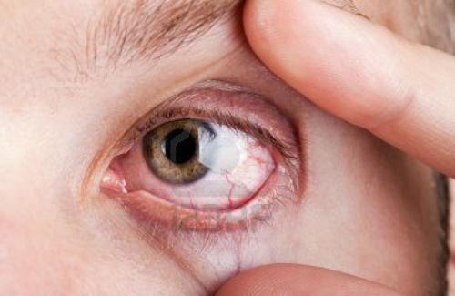 Cách chữa đau mắt hột hiệu quả bằng những mẹo dân gian