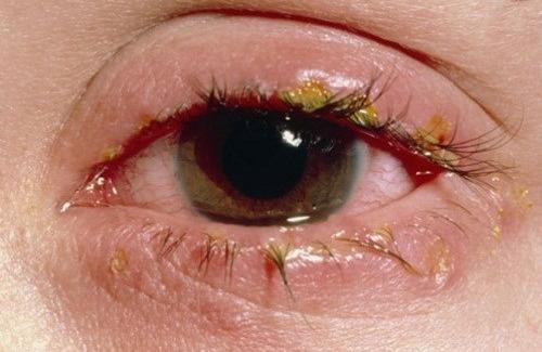 Đau mắt hột như thế nào - các giai đoạn và cách phòng bệnh