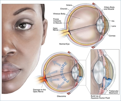 Glaucoma gây bệnh mù lòa và những cách dùng thuốc điều trị hiệu quả