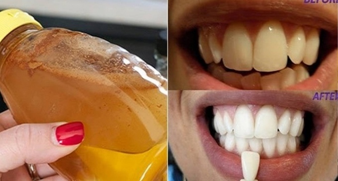 Răng trắng sáng tức thì nhờ nguyên liệu quen thuộc trong bếp nhà bạn