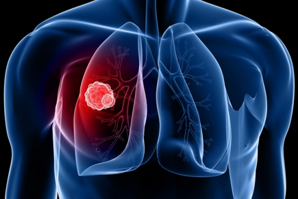 Dấu hiệu nhận biết và điều trị căn bệnh ung thư phổi