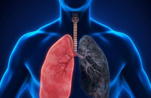 Những dấu hiệu mắc căn bệnh ung thư phổi dễ phát hiện nhất