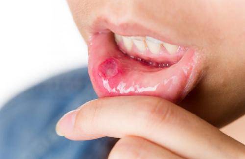 Nguyên nhân và dấu hiệu nhận biết sớm bệnh ung thư miệng cần lưu ý