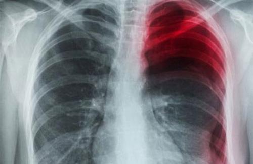 Những nguyên nhân gây ra căn bệnh tràn dịch màng phổi