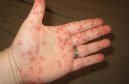 Mức độ nguy hiểm của căn bệnh sốt xuất huyết nên biết