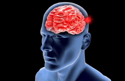 Nguyên nhân tai biến mạch máu não phổ biến nhất là gì?