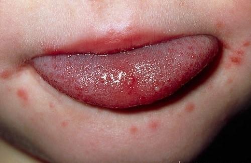 Nhiệt miệng - triệu chứng, nguyên nhân và cách điều trị
