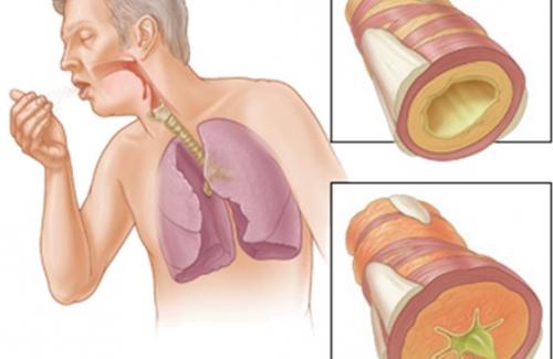 Suy hô hấp mạn: Triệu chứng và nguyên tắc điều trị bệnh