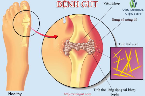 Lưu ý khi dùng thuốc trị tăng acid uric máu trong bệnh gout